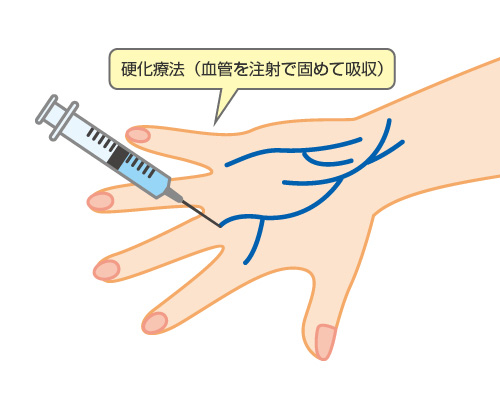 硬化療法(血管を注射で固めて吸収)