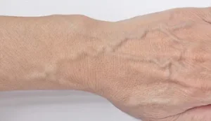 ハンドベイン