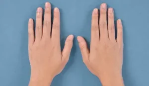 ハンドベインの症例写真