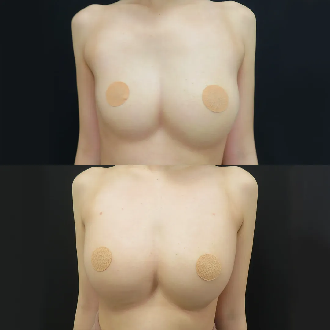 PRP注射プレミアム（お胸）